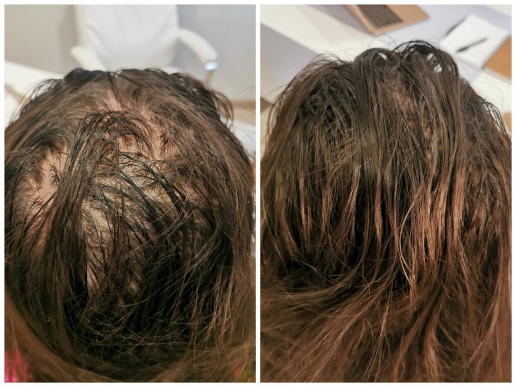 Soin Hydrafacial Keravive cuir chevelu Montpellier