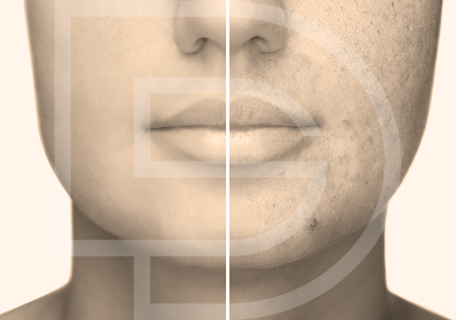 Séance de kératopraxie Dermastories Montpellier